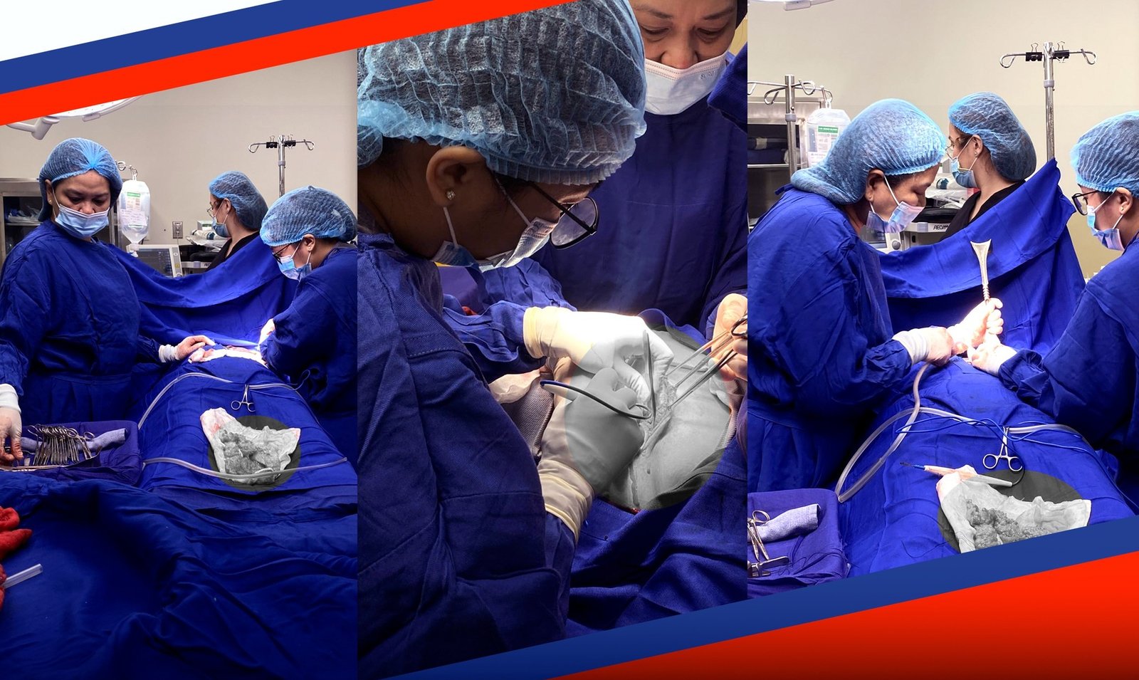 Kauna-unahang Breast Cancer Surgery, matagumpay na isinagawa sa OFW Hospital